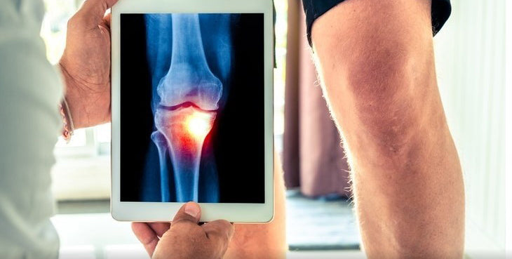 Does Heat Therapy Work for Knee Arthritis ?